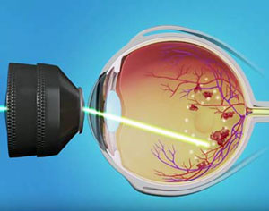 VITREO RETINAL PROCEDURES Barrage laser 1 Quadrant