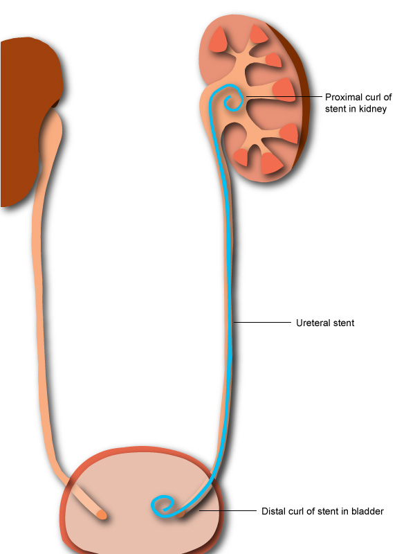 DJ Stent Removal Unilateral Without Anesthesia