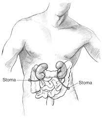 Bilateral Ureterostomy