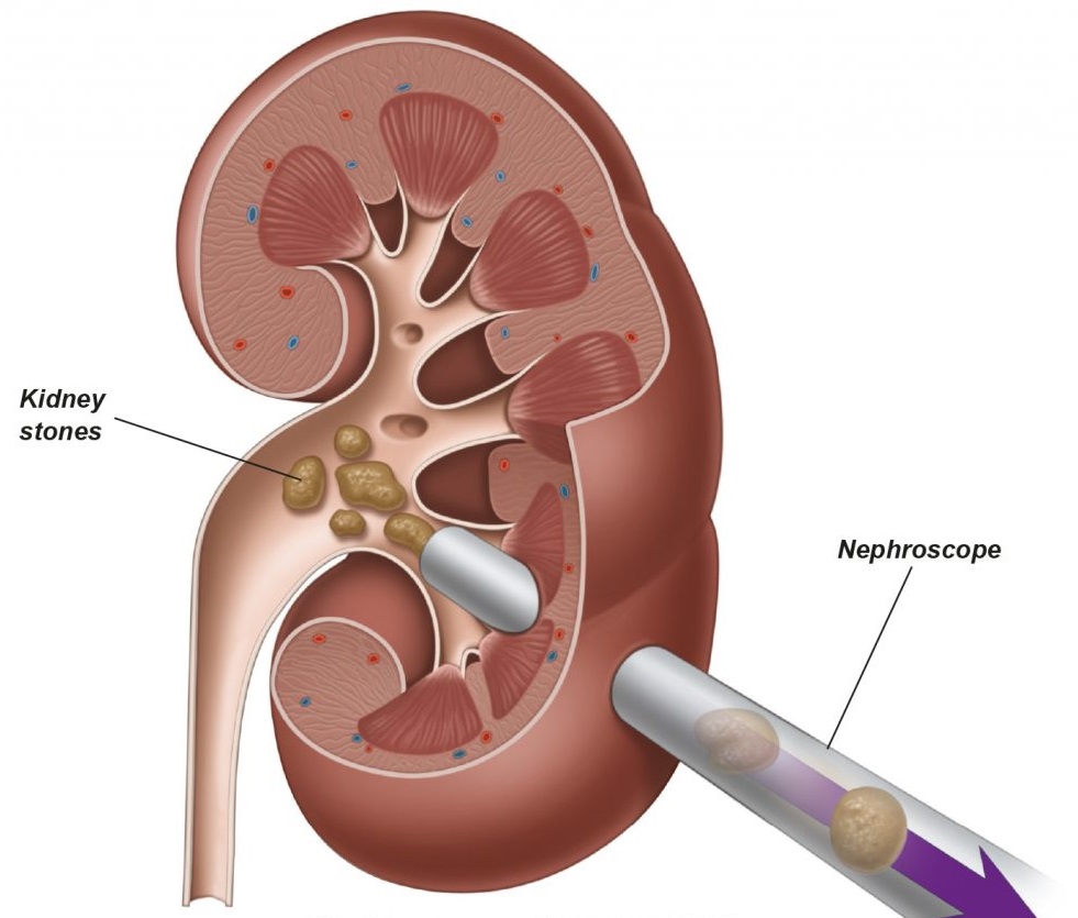 PCNL and Stenting
