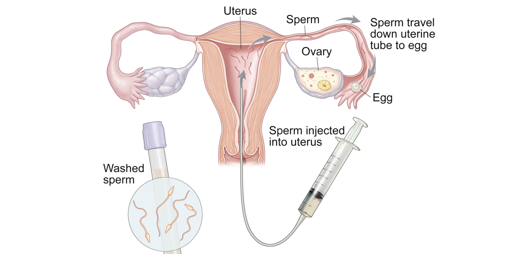 IUI