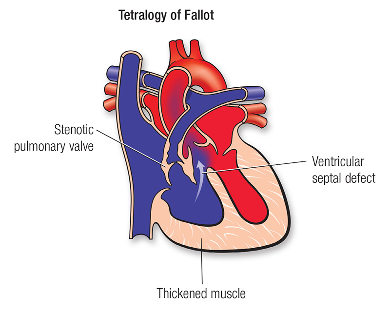TOF treatment