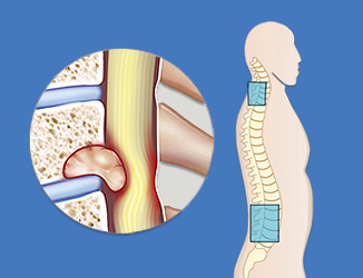 Intramedullary Tumor (Im Tumor) Surgery