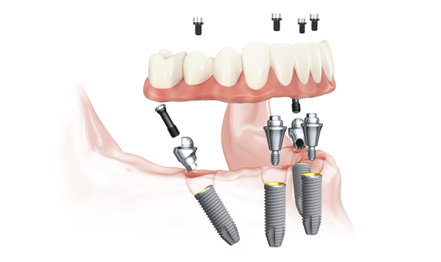 Individual Implants Nobel Active Sweden