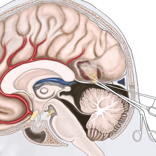 Intraventricular Tumor  Surgery