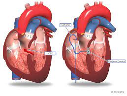 VSD Closure