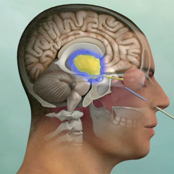 Endoscopic Brain & Skull Base Tumorclival Tumor