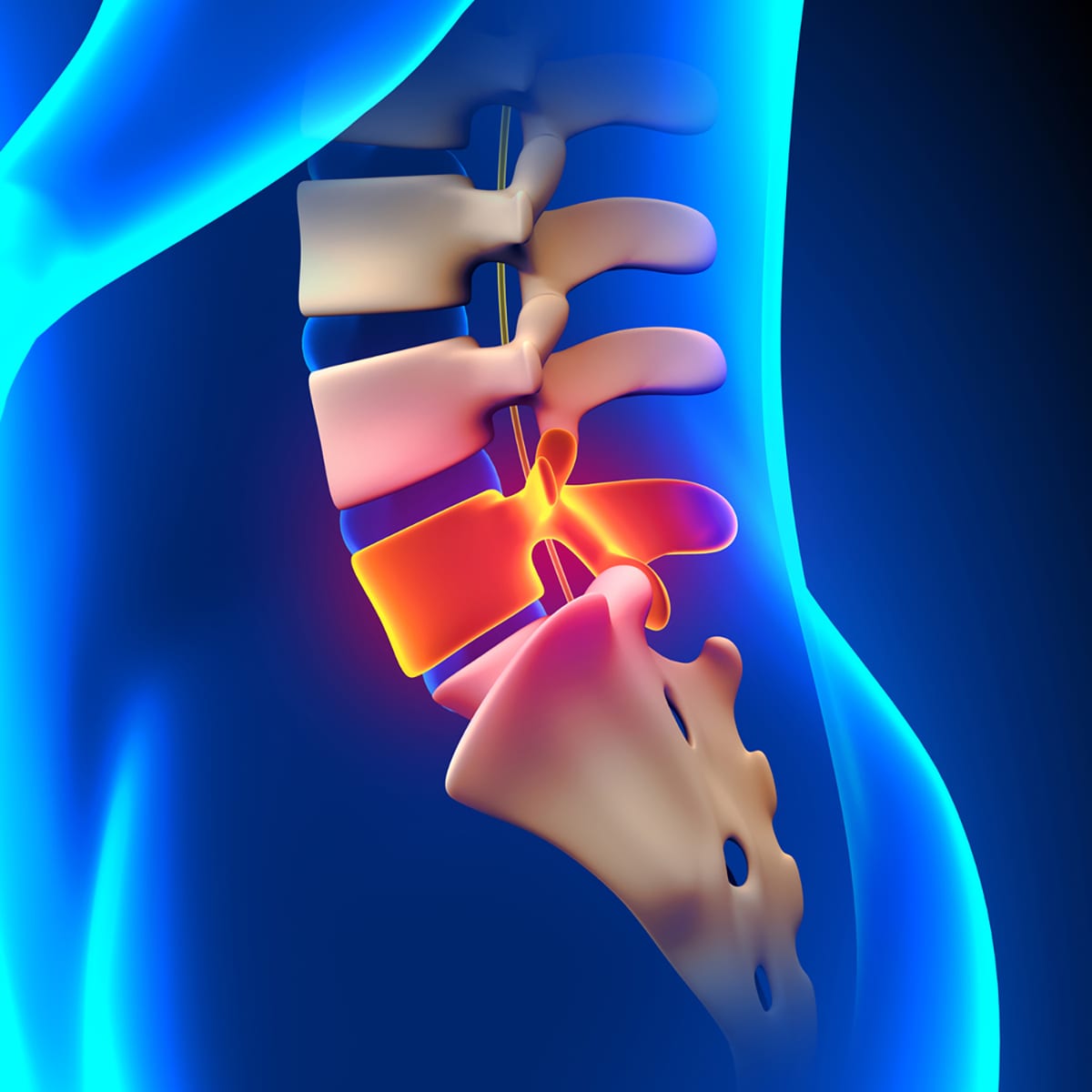 Lumber Micro Discectomy