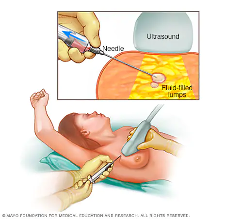 Excision Of Small Fibroadenoma Breast