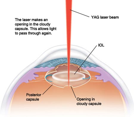 CATARACT YAG Capsulotomy Single Eye