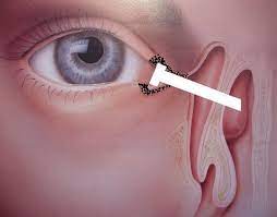 DCT Dacryo Cystectomy Surgery Single Eye