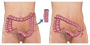 Total Colectomy