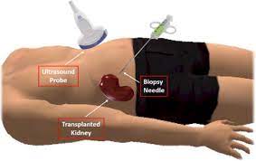 Renal Biopsy Allograft