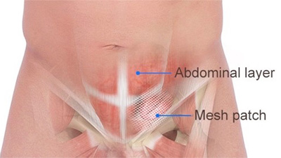 Hernioplasty Inguinal Bilateral with mesh