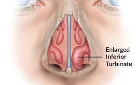 Monopolar Cautery Turbinate  Reduction