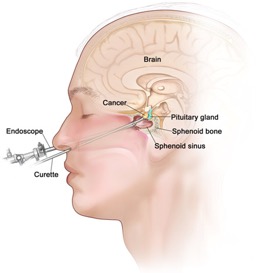 Endoscopic TNTS