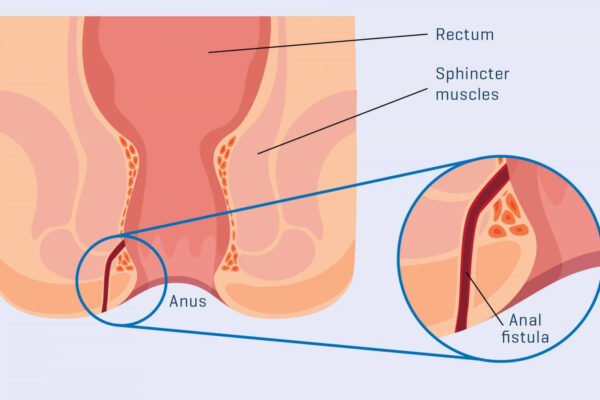 Fistulectomy - High - With Laser