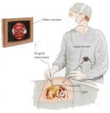 Lap Inguinal Hernia Ul