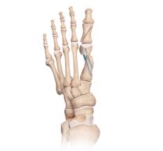 Valgus Osteotomy And fixation