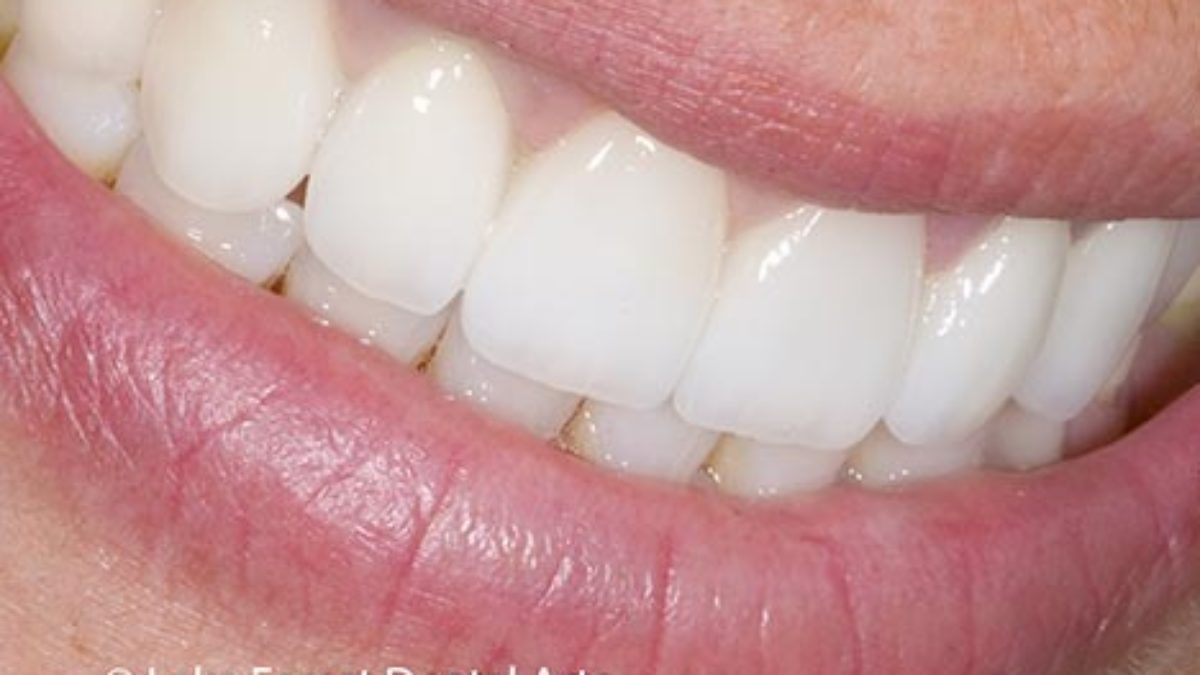 Full Mouth Implant for Upper Jaw 10 implants including 2 Pterygoid implants and 14 units Ceramic bri