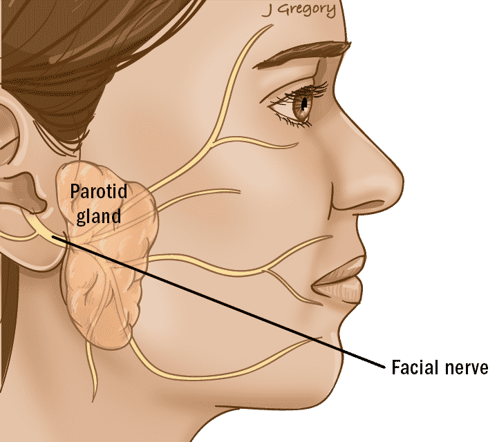 Superficial Parotidectomy