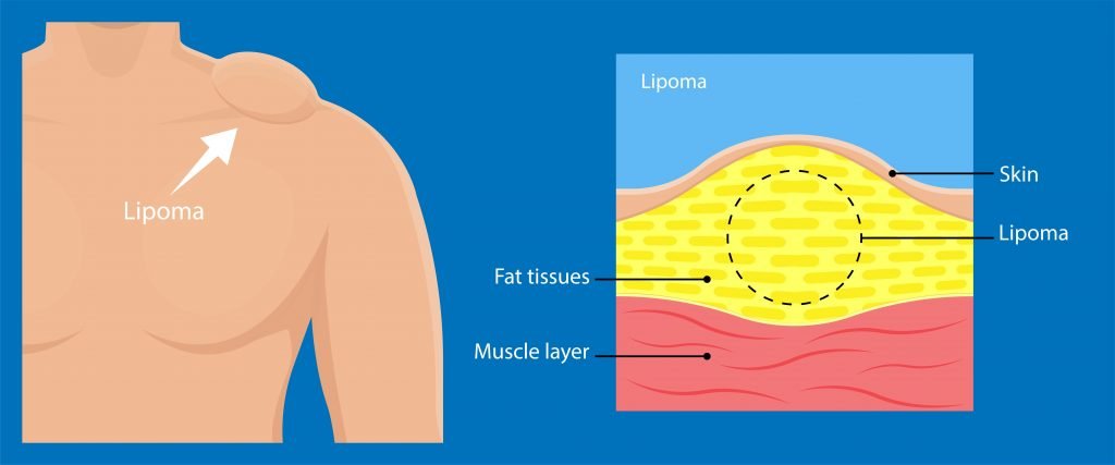 Lipoma Under GA
