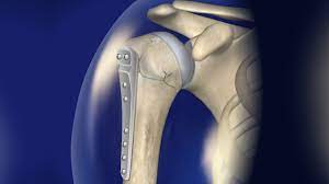Open Reduction Dislocation Major