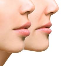 Lip Reduction