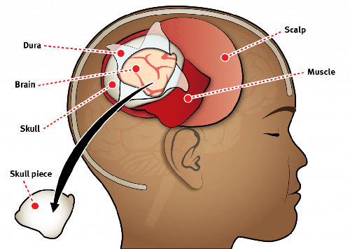 Craniotomy & excision of Tumor