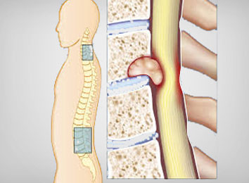 Spinal Tumor Excision With Fixation