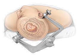 Excision Of Meningioma