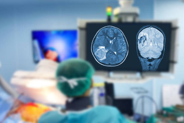 Brain Tumor Surgery, India
