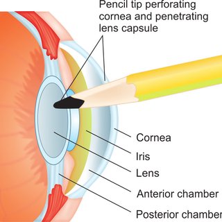 CORNEAL AND OCULAR SURFACE PROCEDURES-Perforating Corneoscleral Injury repair (including Anterior Vi