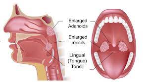 Excision Sinus