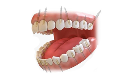 Full Mouth Implant for Upper Jaw 10 to12 implants including 2 Pterygoid implants and 14 units Metal