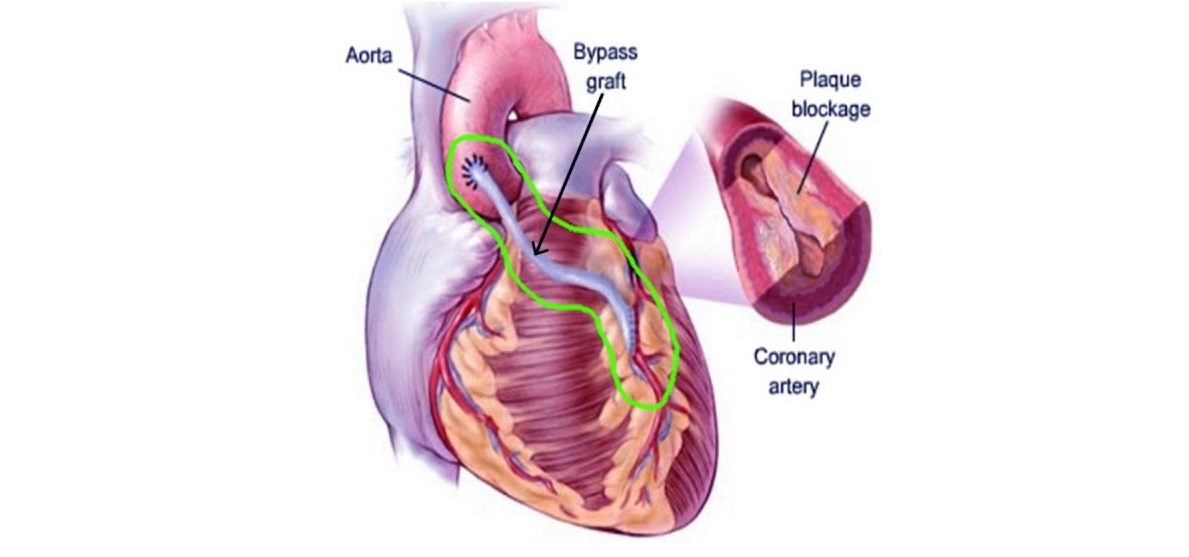 CABG and MVR
