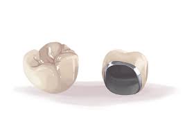 Porcelain Fused to Metal Crown