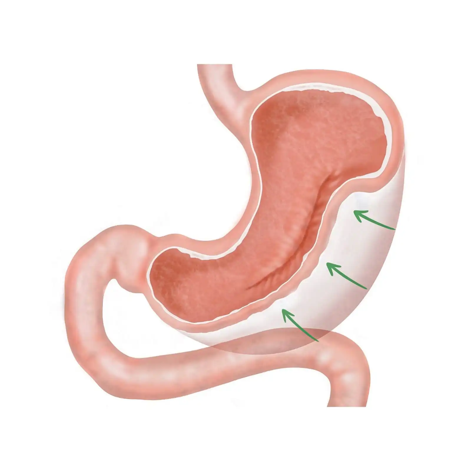 Gastroplasty