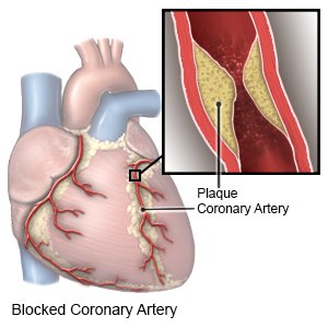 Coronary Artery Surgery