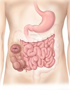 Colostomy