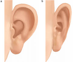 Ear Surgery (Pinnaplasty)