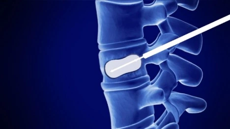 Kyphoplasty