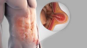 Abdominal hernia surgery