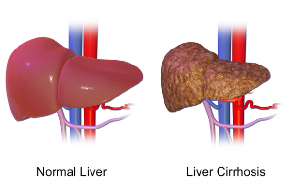 Liver Cirrhosis Treatment