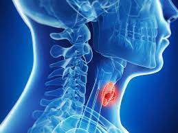 Laryngectomy, United Arab Emirates