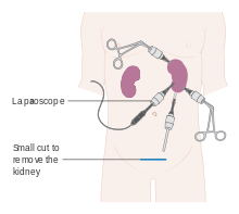 Radical Nephrectomy