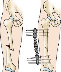 Fracture Campla (with device)
