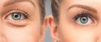 Blepharoplasty 4 Eyelid