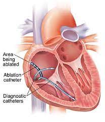 EPS and Ablation