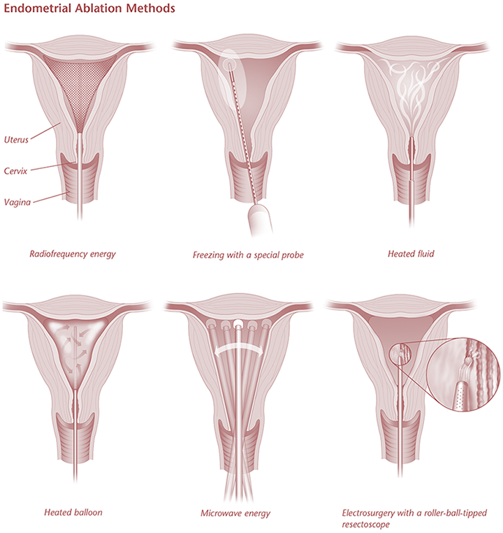 Microwave Endometrial Ablation, United Arab Emirates